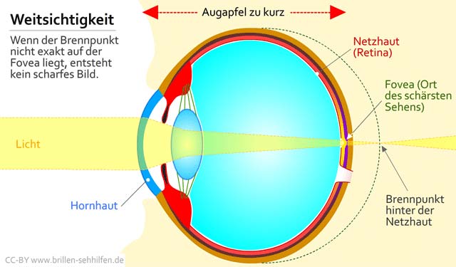 Farsightedness