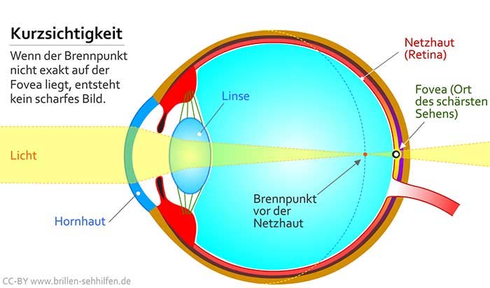 Myopia (nearsightedness)
